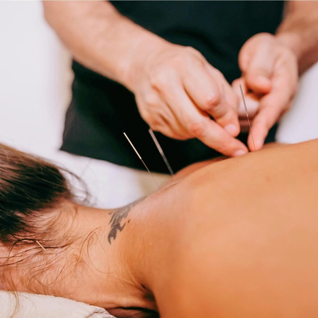 Chiropractor performing dry needling on a patient’s upper back to relieve muscle tension and trigger point pain.